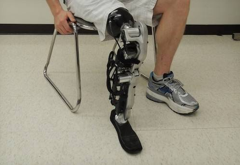 河南假肢:手術(shù)后什么時(shí)候安裝假肢好(圖1) 河南假肢:手術(shù)后什么時(shí)候安裝假肢好(圖1)